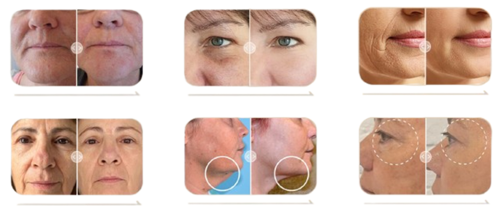 AntesDepois-transparente-1280 Dermolift