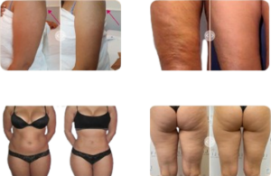 Corporal-R Tratamento corporal Dermolift